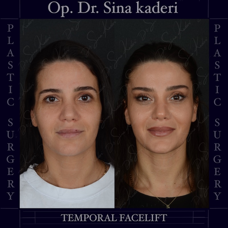 Temporal Lift: Эстетическое и пластическое вмешательство, оживляющее выражение верхней и средней зоны лица